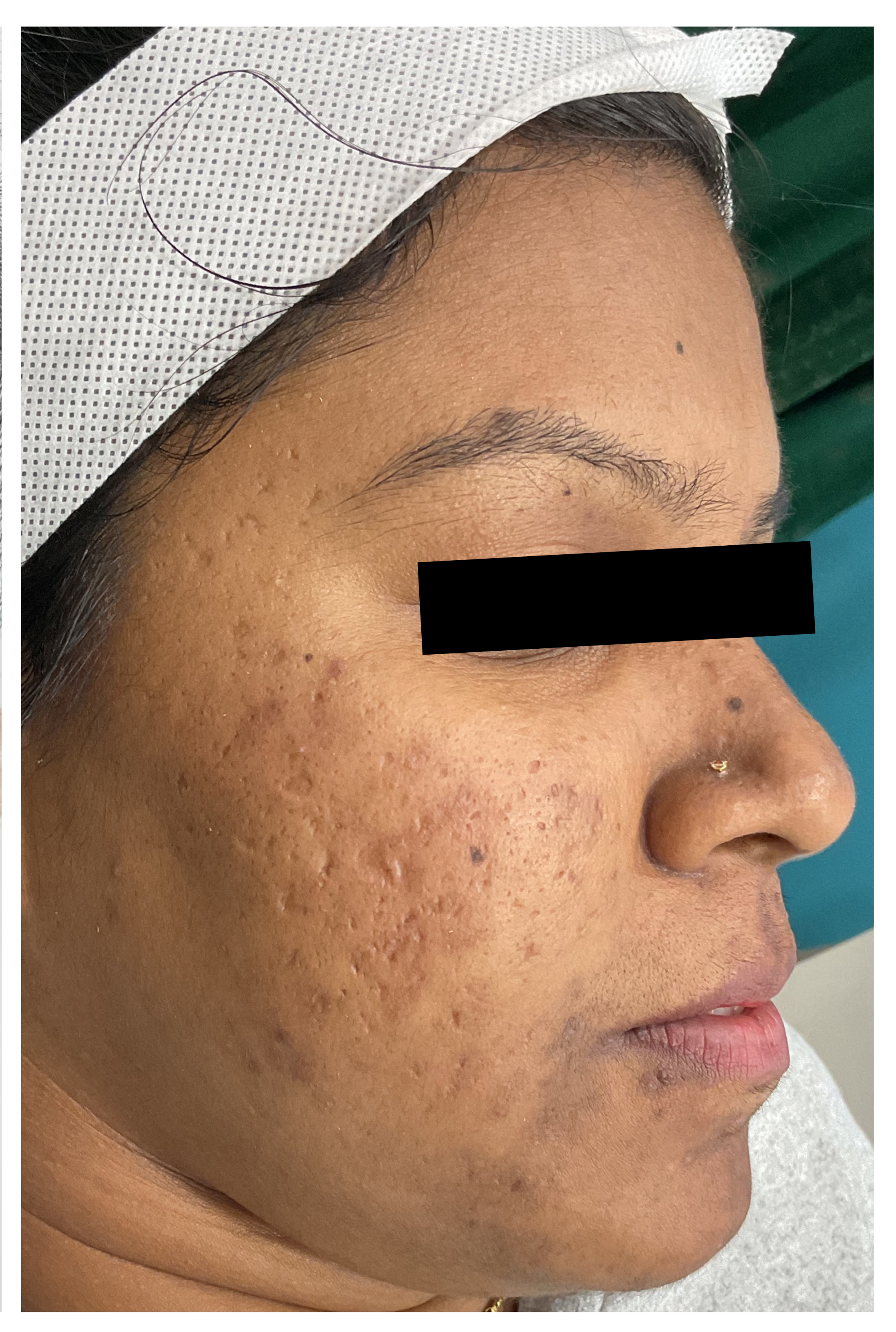 After Laser Hair Removal